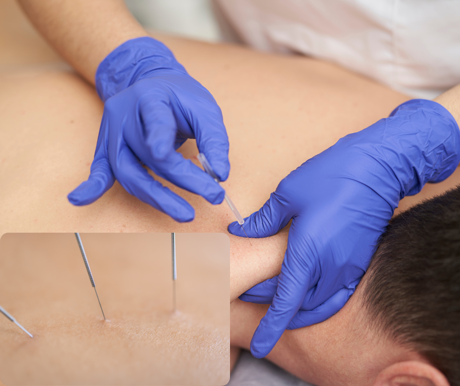 Dry needling therapy session for muscle pain relief at The Renew Studio Romeo MI